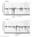 Fig. 01 - Markers of DNA copy number alteration for improved prognostication in prostate cancer