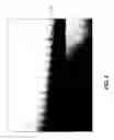 Fig. 09 - Composite ePTFE/textile prosthesis