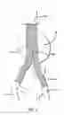 Fig. 02 - Methods and Devices for Contributing to the Treatment of Aneurysms