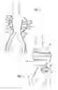 Fig. 03 - Methods and Devices for Contributing to the Treatment of Aneurysms