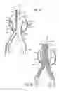 Fig. 05 - Methods and Devices for Contributing to the Treatment of Aneurysms