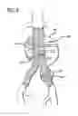 Fig. 06 - Methods and Devices for Contributing to the Treatment of Aneurysms