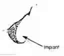 Fig. 01 - Compositions for breast implant filling and methods of use