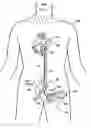 Fig. 01 - Multilumen catheter for minimizing limb ischemia