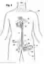 Fig. 04 - Multilumen catheter for minimizing limb ischemia