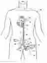 Fig. 01 - Multilumen catheter for minimizing limb ischemia