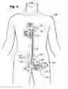 Fig. 04 - Multilumen catheter for minimizing limb ischemia