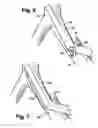 Fig. 05 - Multilumen catheter for minimizing limb ischemia