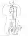 Fig. 01 - Implantable heart assist system and method of applying same