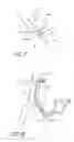 Fig. 08 - Implantable heart assist system and method of applying same