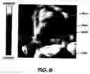 Fig. 07 - Forehead sensor placement