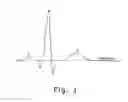 Fig. 02 - Method and device for determining the presence of an ischemic area in the heart of a human being or an animal