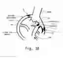 Fig. 05 - Method and device for determining the presence of an ischemic area in the heart of a human being or an animal