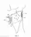 Fig. 06 - Dome-shaped back brace