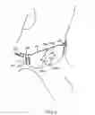 Fig. 07 - Dome-shaped back brace