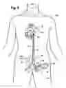 Fig. 04 - Multilumen catheter for minimizing limb ischemia