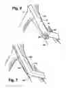 Fig. 05 - Multilumen catheter for minimizing limb ischemia