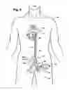 Fig. 04 - Multilumen catheter for minimizing limb ischemia