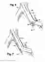Fig. 05 - Multilumen catheter for minimizing limb ischemia