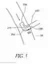 Fig. 06 - Cannulae having a redirecting tip