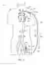 Fig. 07 - Cannulae having a redirecting tip