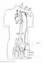 Fig. 01 - Cannulae having a redirecting tip