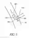 Fig. 06 - Cannulae having a redirecting tip