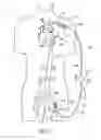 Fig. 07 - Cannulae having a redirecting tip