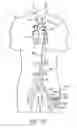 Fig. 11 - Cannulae having a redirecting tip