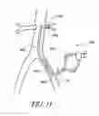 Fig. 12 - Cannulae having a redirecting tip