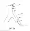 Fig. 15 - Cannulae having a redirecting tip