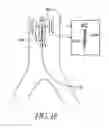 Fig. 17 - Cannulae having a redirecting tip