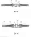 Fig. 10 - Apparatus and method for delivering therapeutic and/or other agents to the inner ear and to other tissues