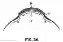 Fig. 04 - Scleral lenses for custom optic evaluation and visual performance improvement
