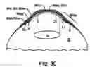 Fig. 06 - Scleral lenses for custom optic evaluation and visual performance improvement