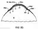 Fig. 07 - Scleral lenses for custom optic evaluation and visual performance improvement