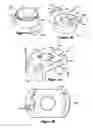 Fig. 07 - Multistage spinal fixation locking mechanism