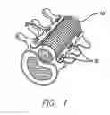 Fig. 02 - Bone anchored surgical mesh