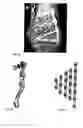 Fig. 03 - Osteosynthesis plate set