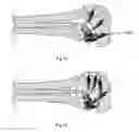 Fig. 19 - Methods of using minimally invasive actuable bone fixation devices