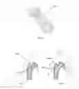 Fig. 24 - Methods of using minimally invasive actuable bone fixation devices