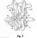 Fig. 03 - Devices and techniques for a posterior lateral disc space approach