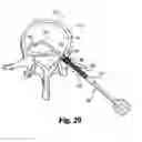 Fig. 16 - Devices and techniques for a posterior lateral disc space approach