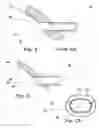 Fig. 03 - Intraocular lens injection nozzle