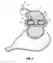 Fig. 03 - Gastric restrictor assembly and method of use