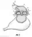 Fig. 04 - Gastric restrictor assembly and method of use