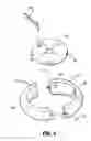 Fig. 05 - Gastric restrictor assembly and method of use