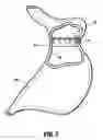 Fig. 07 - Gastric restrictor assembly and method of use