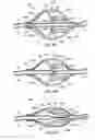 Fig. 08 - Apparatus and methods for clearing obstructions from surgical cutting instruments
