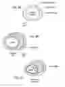 Fig. 04 - Method and apparatus for treating vulnerable plaque